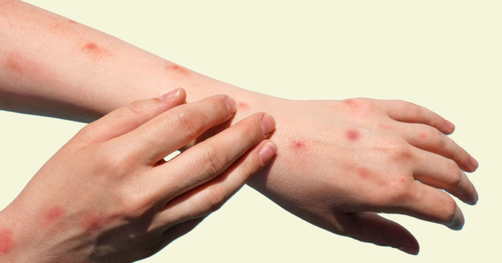 Close-up of hands and arms with red lesions and rash, showing symptoms of monkeypox.